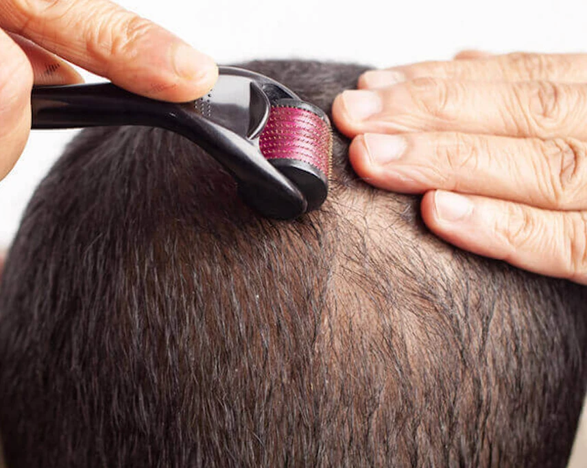 Hair-Loss-Treatment-through-Dermaroller-b