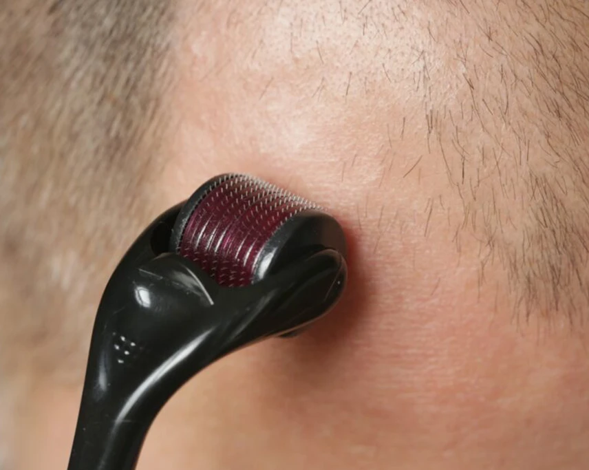 Hair-Loss-Treatment-through-Dermaroller-c