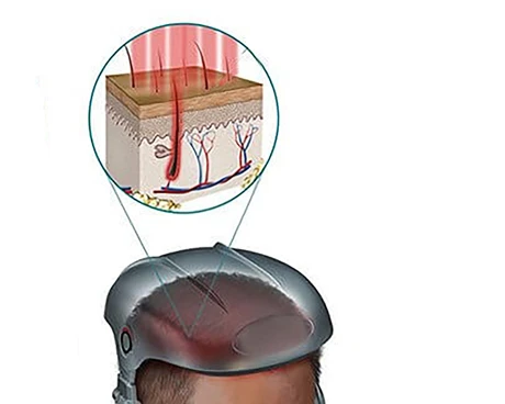 Low-level-laser-theraphy