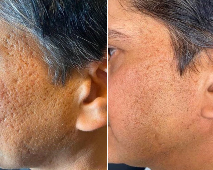 Microneedling-RF-treatment-b