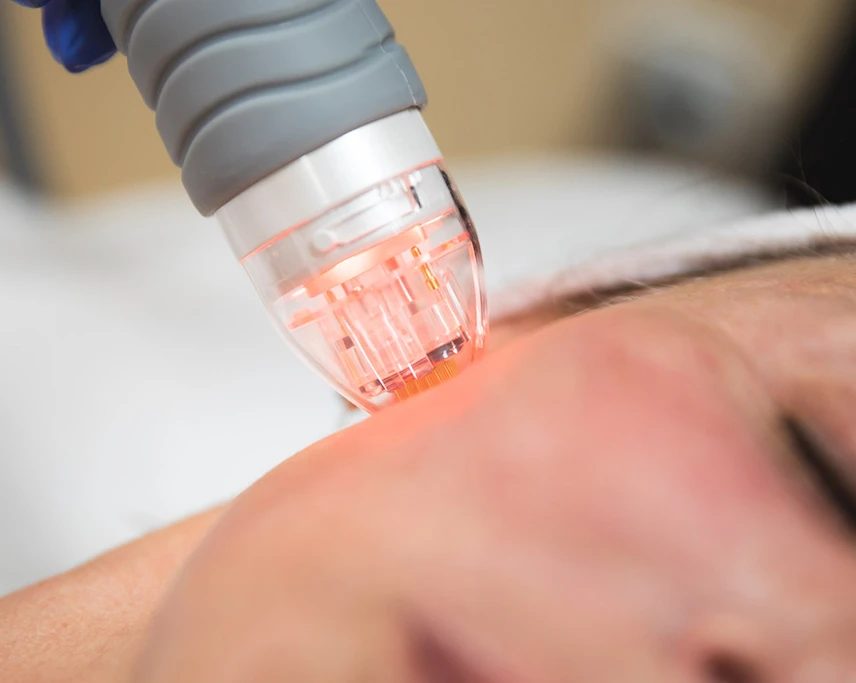 Microneedling-RF-treatment-c