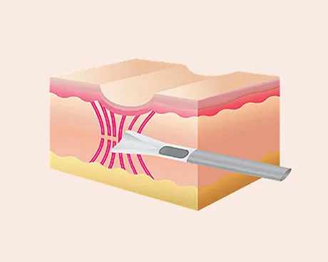 Subcision-for-Scars