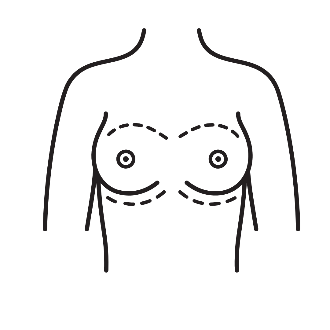 Breast Reduction by Traditional Surgery at ko cosmetic surgery centre in combatore