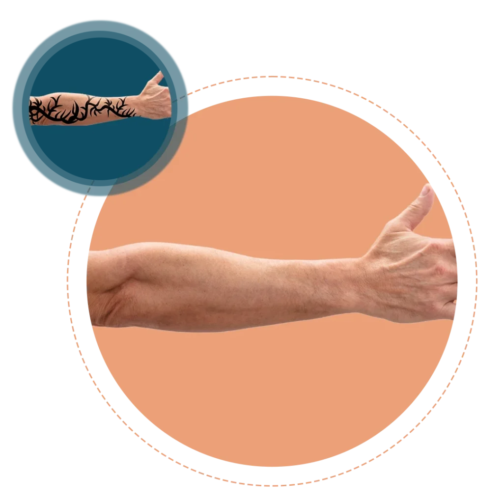 Laser Tattoo Removal