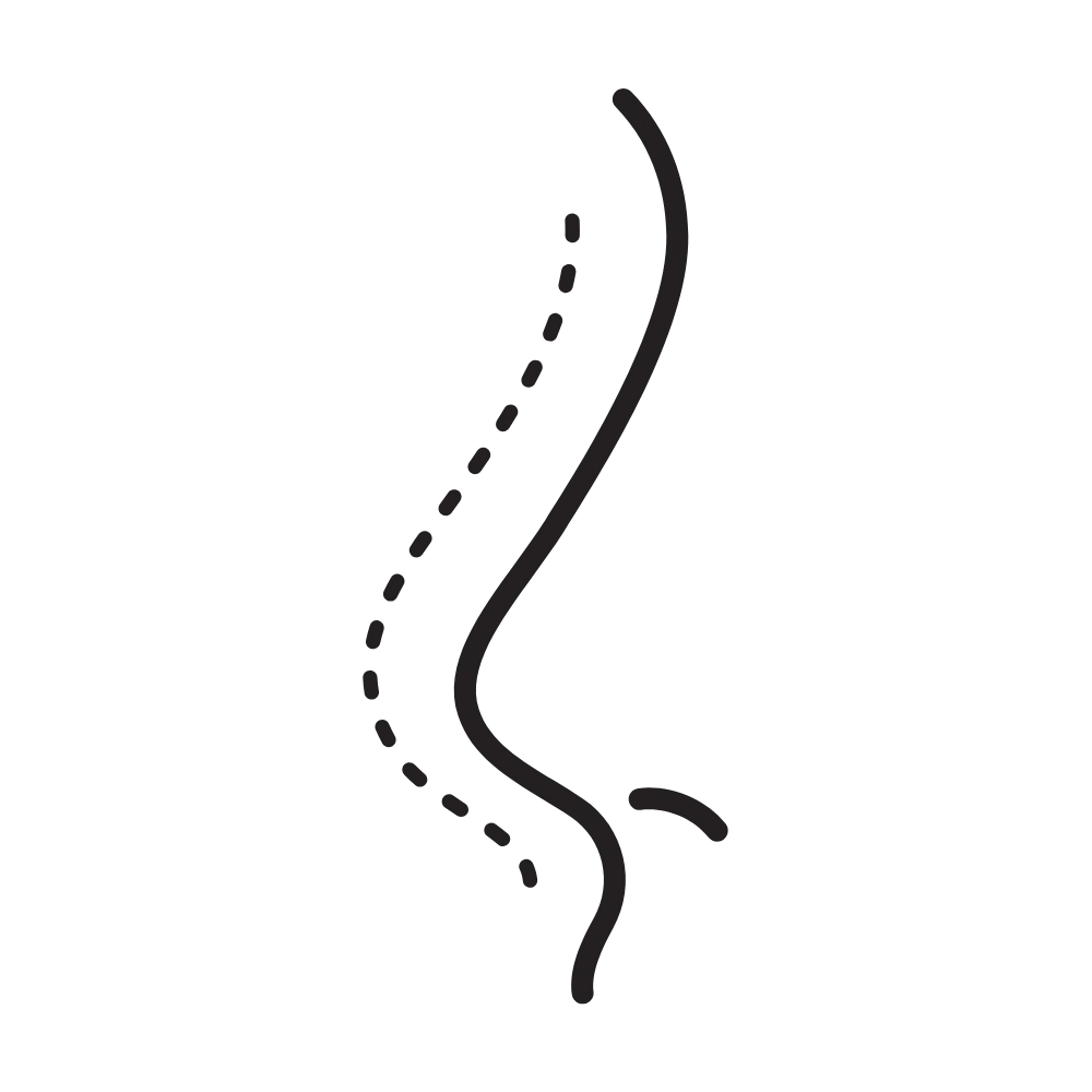 Rhinoplasty