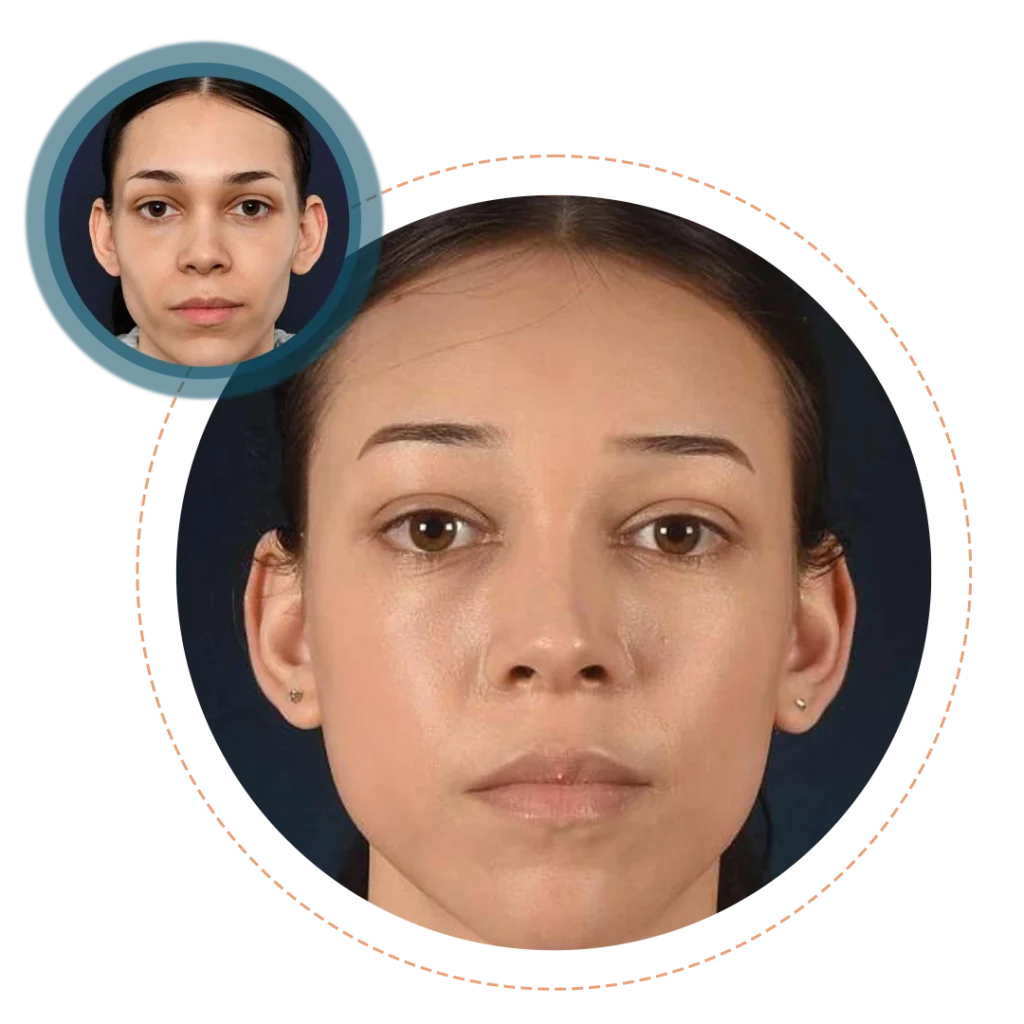 Facial Feminization Surgery