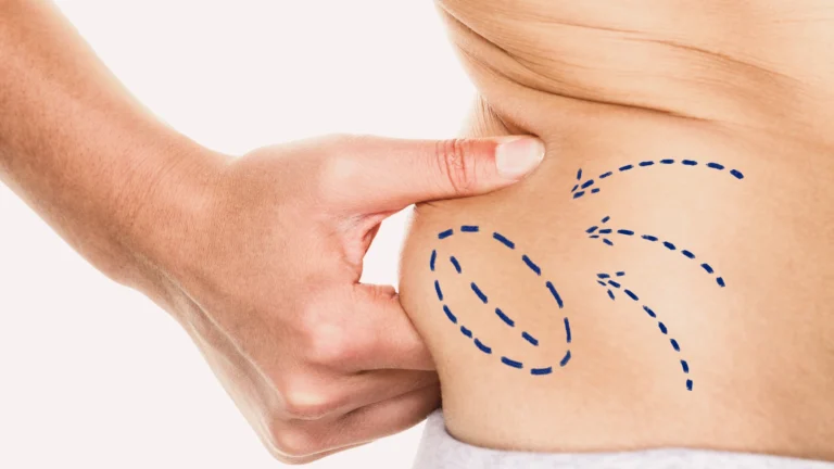 Truth About Liposuction vs. Non-Surgical Fat Reduction