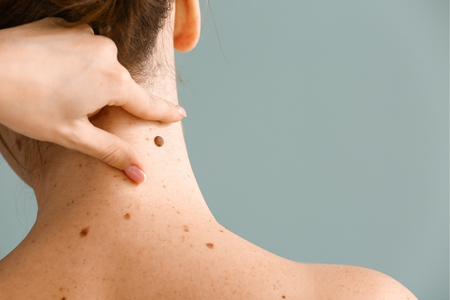 Mole & Wart Removal—Why Surgical Removal Is the Safest Option