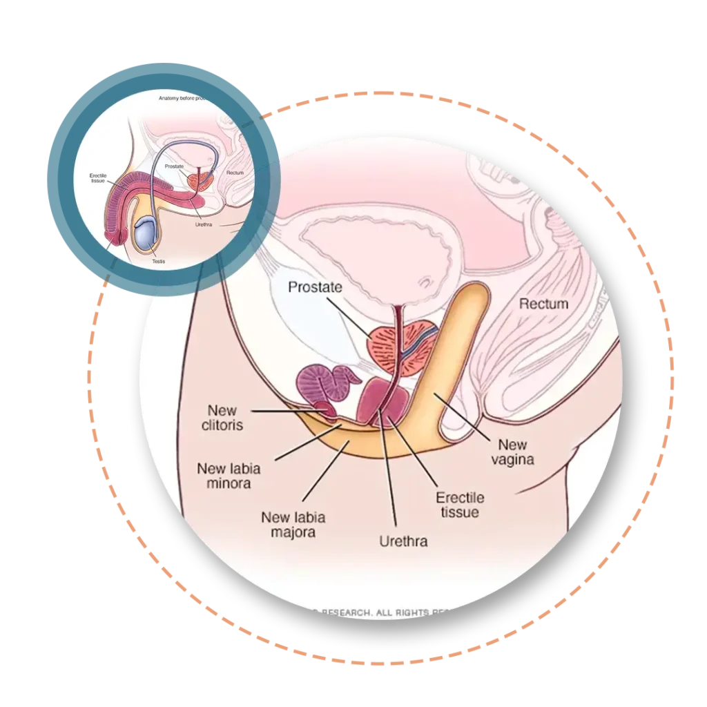 Penile Inversion Vaginoplasty Before After image