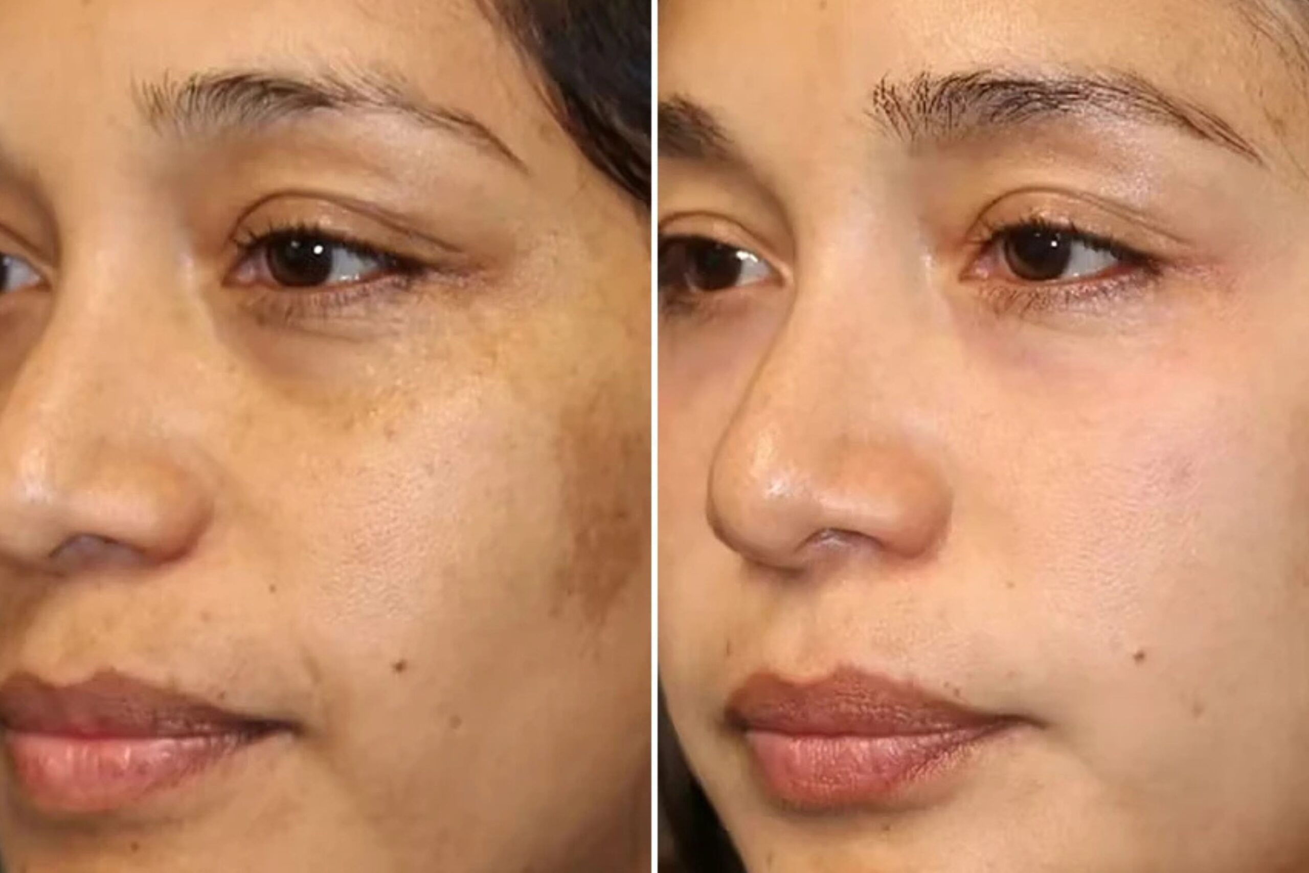 Fat Grafting into Scars Treatment provide by Ko cosmetic surgery centre