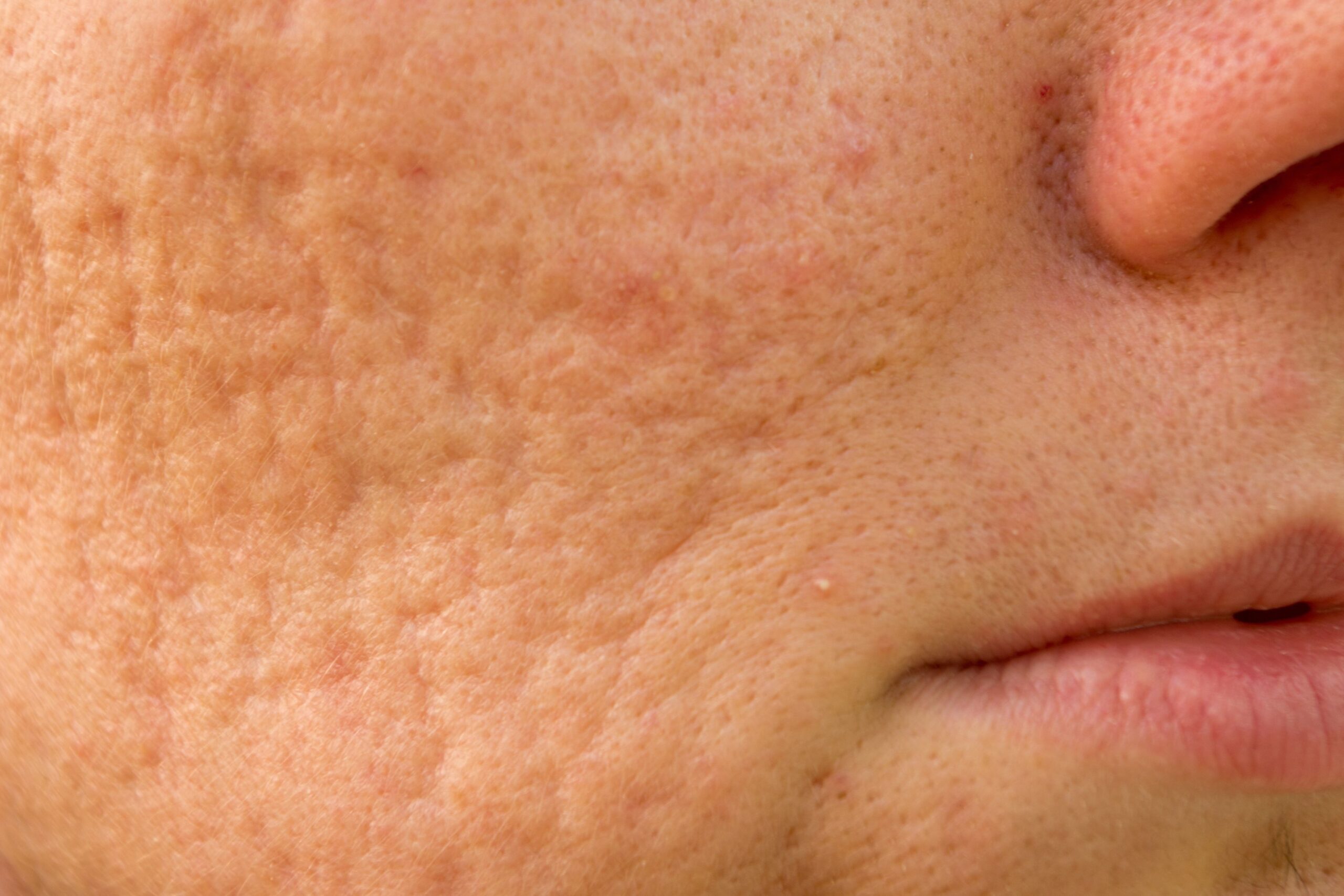 Subcision for Scars Treatment provide by Ko cosmetic surgery centre