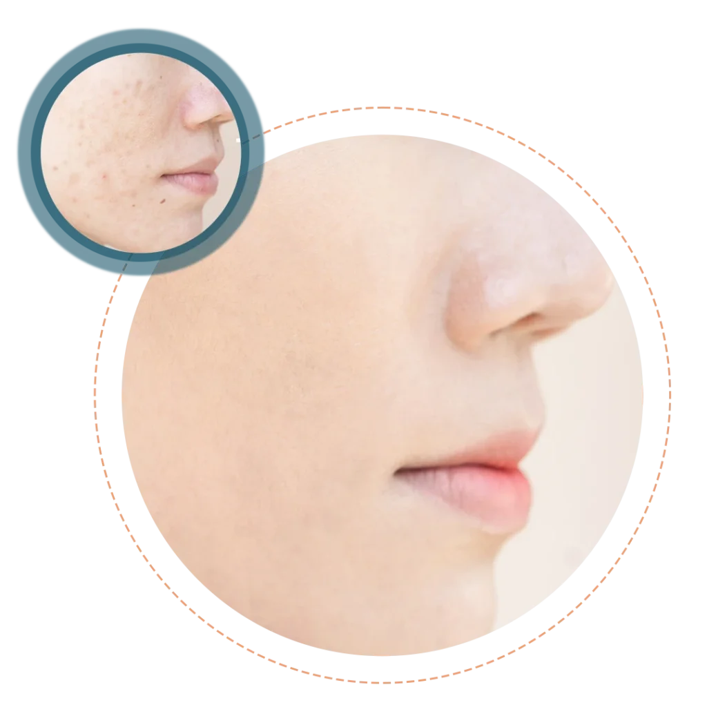 Fractional CO2 laser treatment for stretch marks and skin resurfacing in Coimbatore