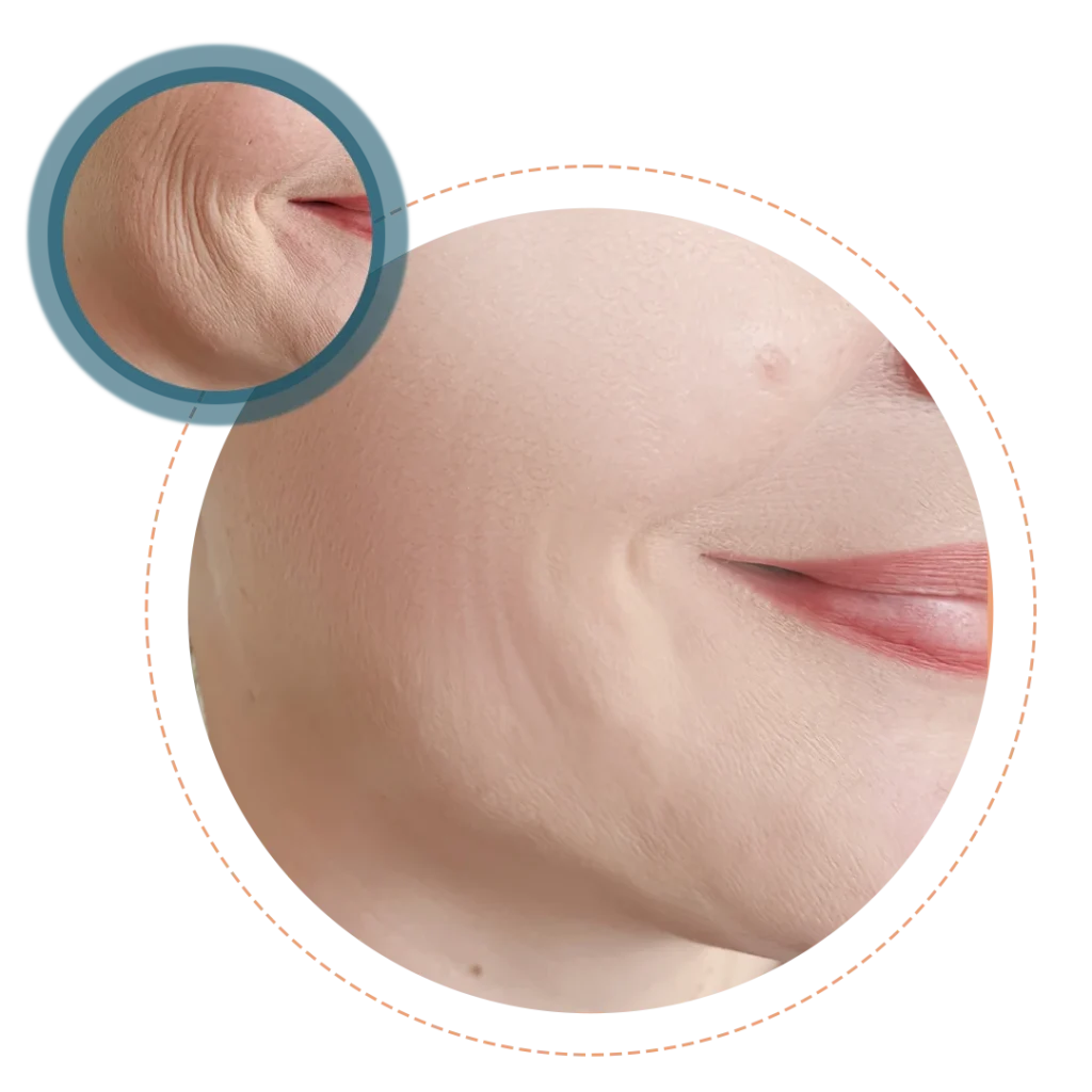 HIFU skin tightening treatment