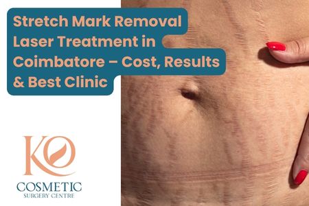Stretch Mark Removal Laser Treatment in Coimbatore – Cost, Results & Best Clinic