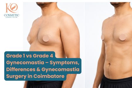 Grade 1 vs Grade 4 Gynecomastia – Symptoms, Differences & Gynecomastia Surgery in Coimbatore